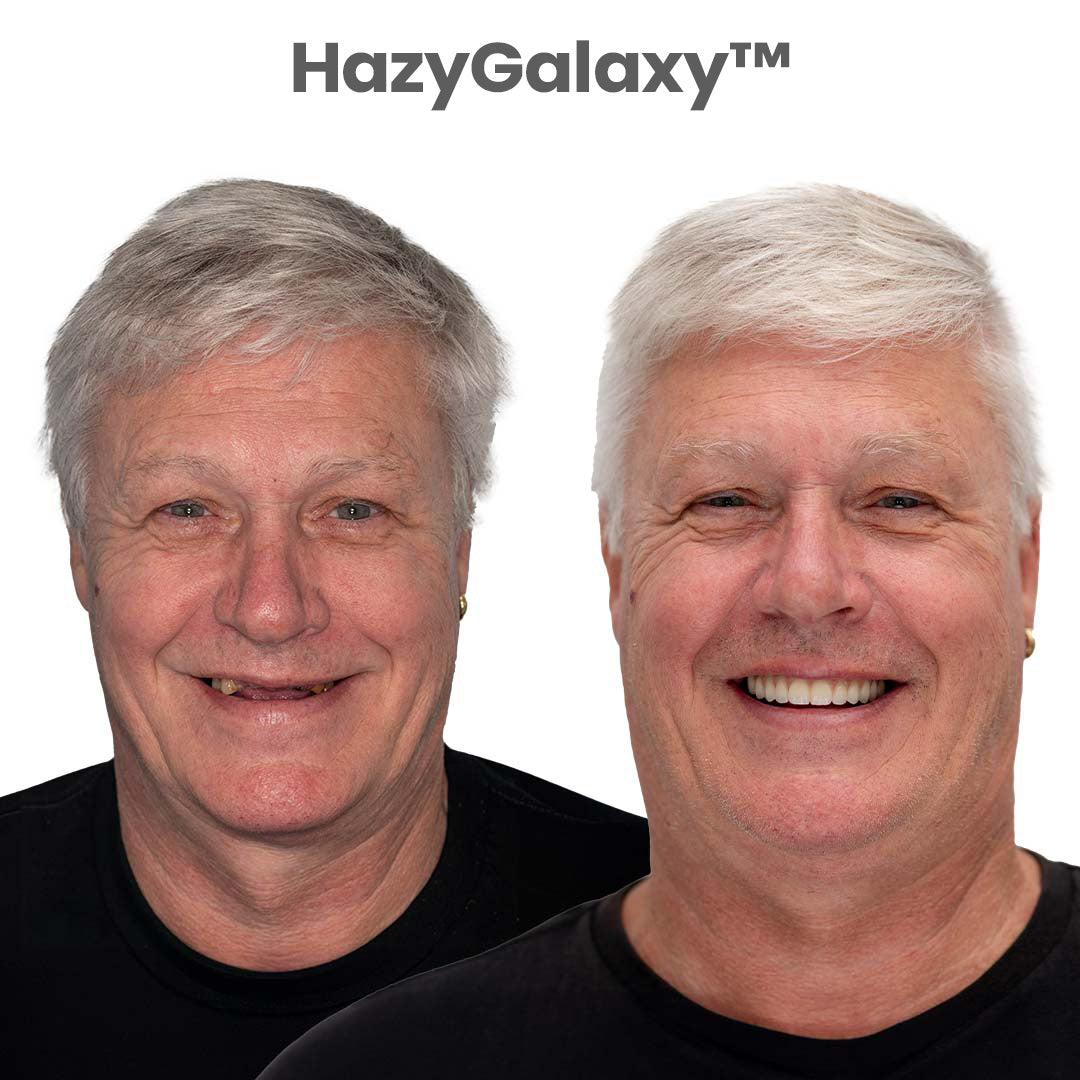 ⏰ HazyGalaxy™ Custom-Fit Dentures ⏰ ENDS TODAY 70% OFF | Smile with Confidence